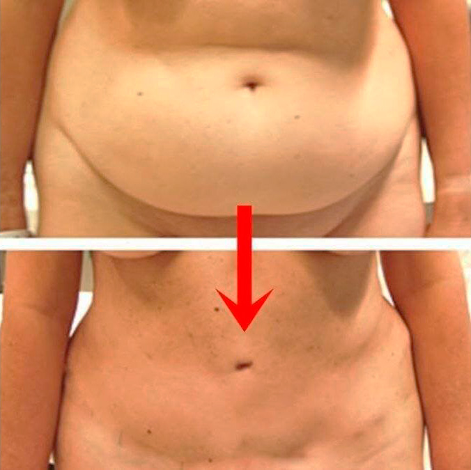 Karın Bölgesi Önce Sonra